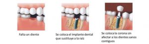 Implantes Dentales Salou Tarragona