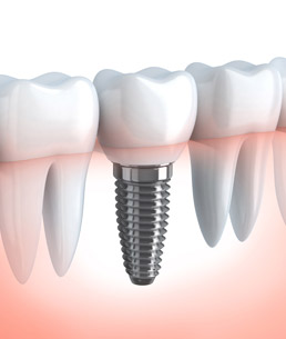 IMPLANTOLOGY