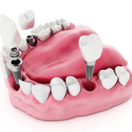 Dental Implants Tarragona