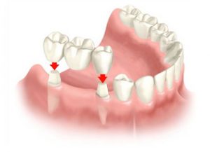 Fixed Prosthesis