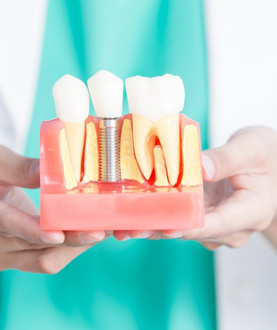 dental implants in Salou and Tarragona