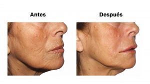 hyaluronic acid in Salo and Tarragona