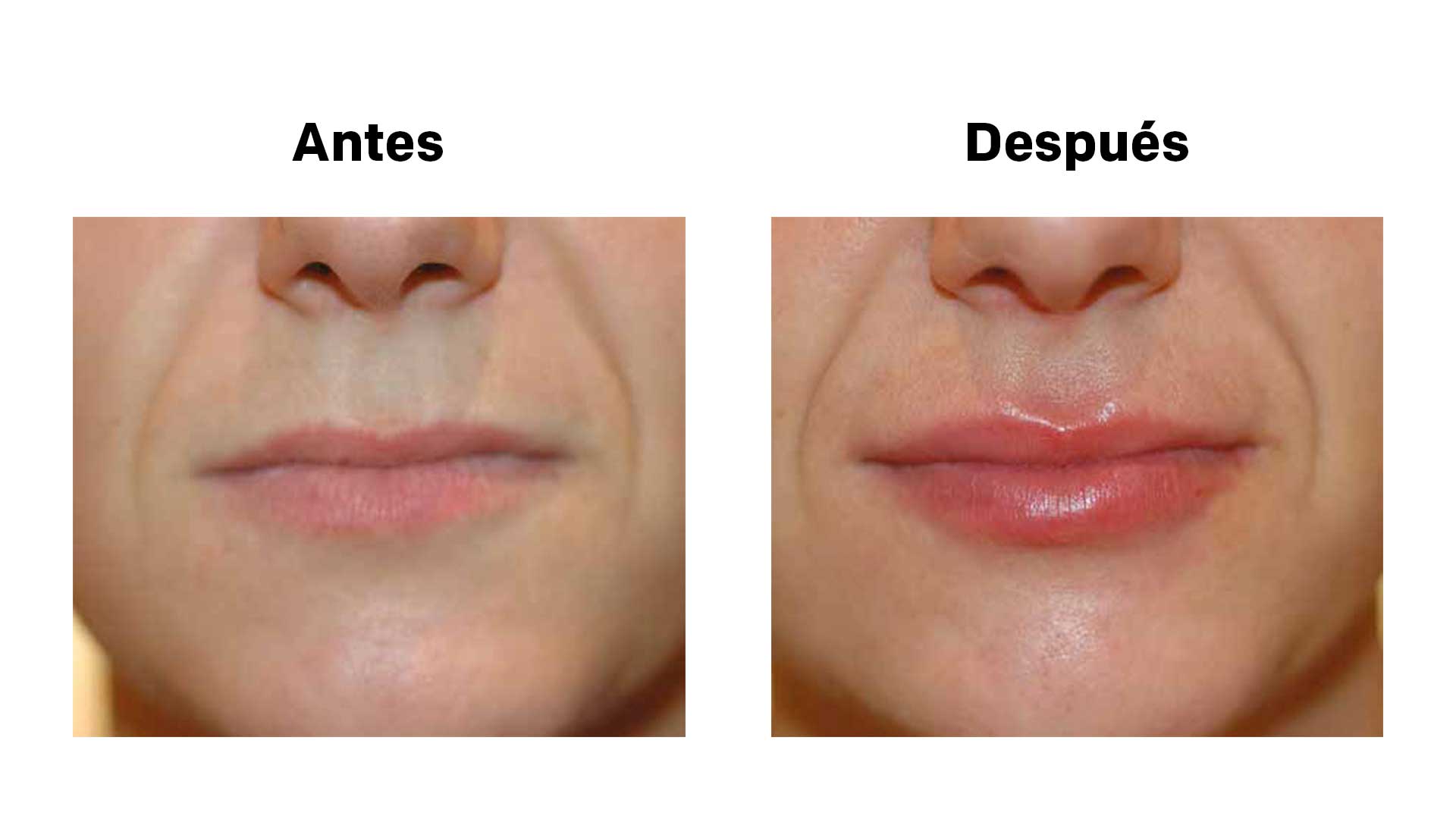 hyaluronic acid in Salo and Tarragona