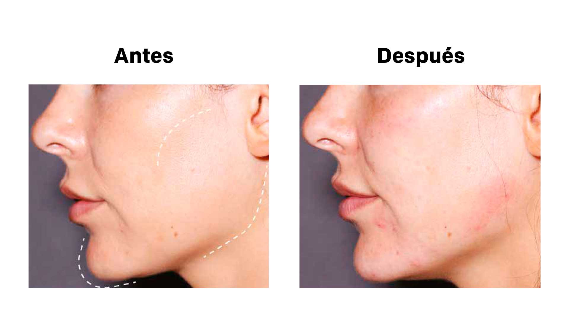 hyaluronic acid in Salo and Tarragona