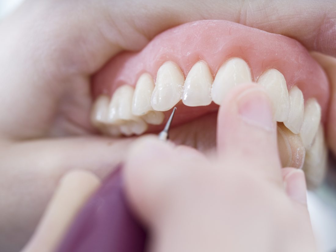 Prótesis dentales, ¿cómo se clasifican?
