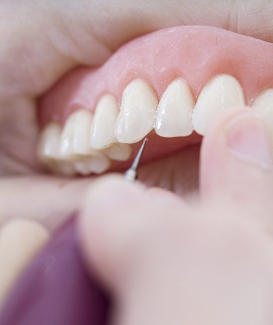 Prótesis dentales, ¿cómo se clasifican?