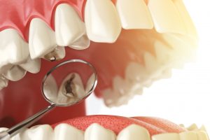 ¡La caries es una enfermedad infecciosa!