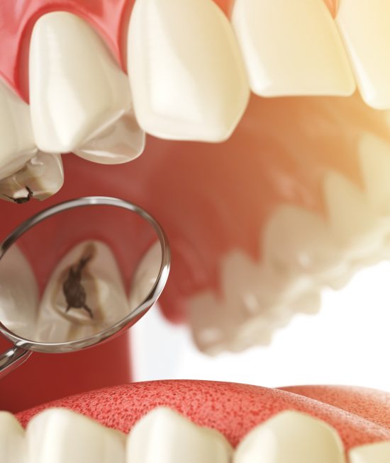 ¡La caries es una enfermedad infecciosa!