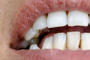 Tout sur les taches de dents !